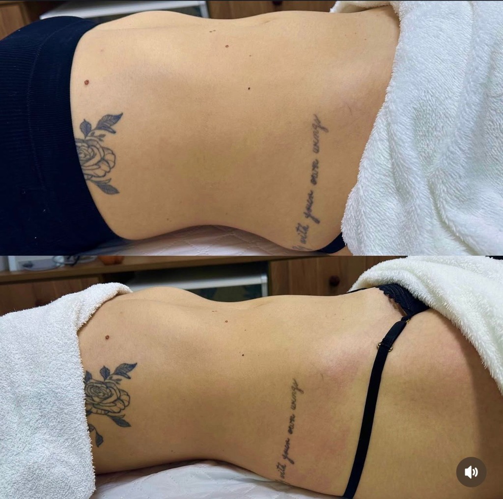 Antes e Depois Drenagem Linfática