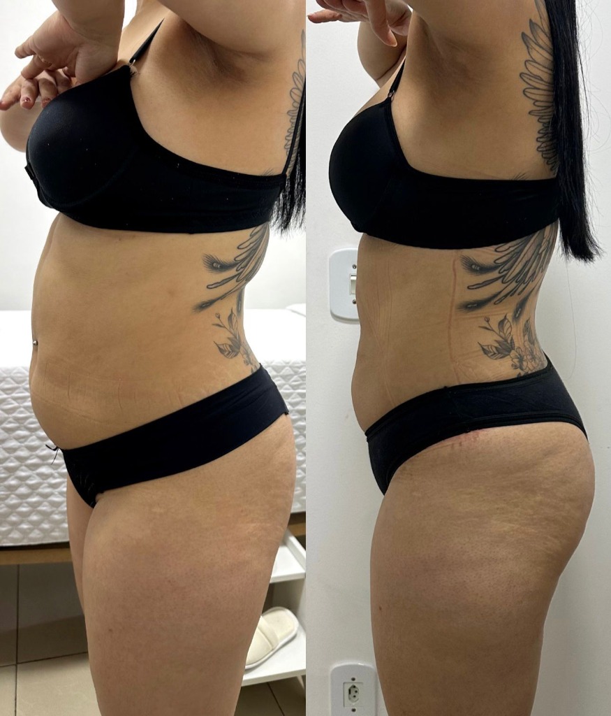 Antes e Depois Crio Detox Slim