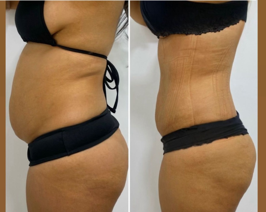 Antes e Depois Slim One