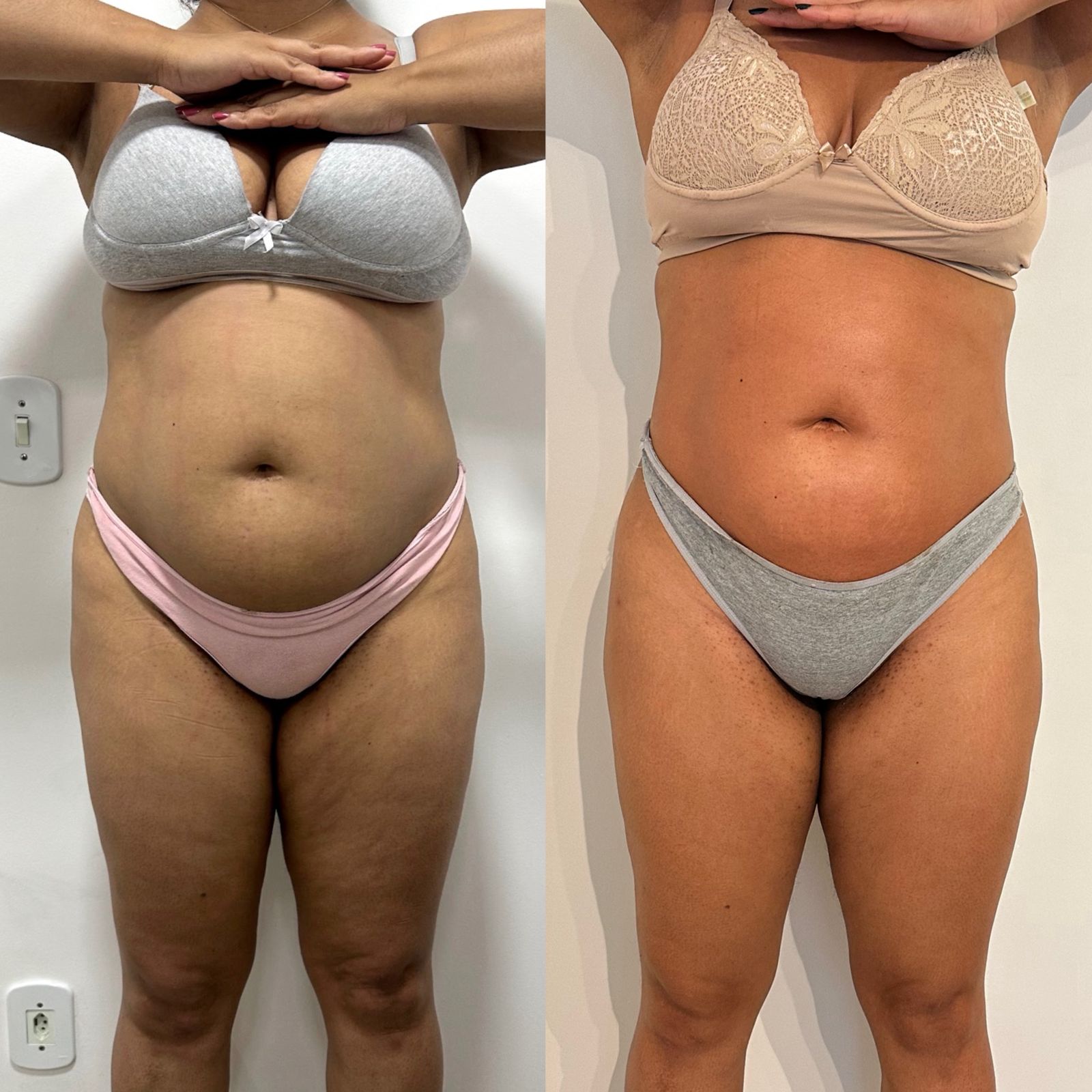 Resultado de Harmonização Corporal — Slim One