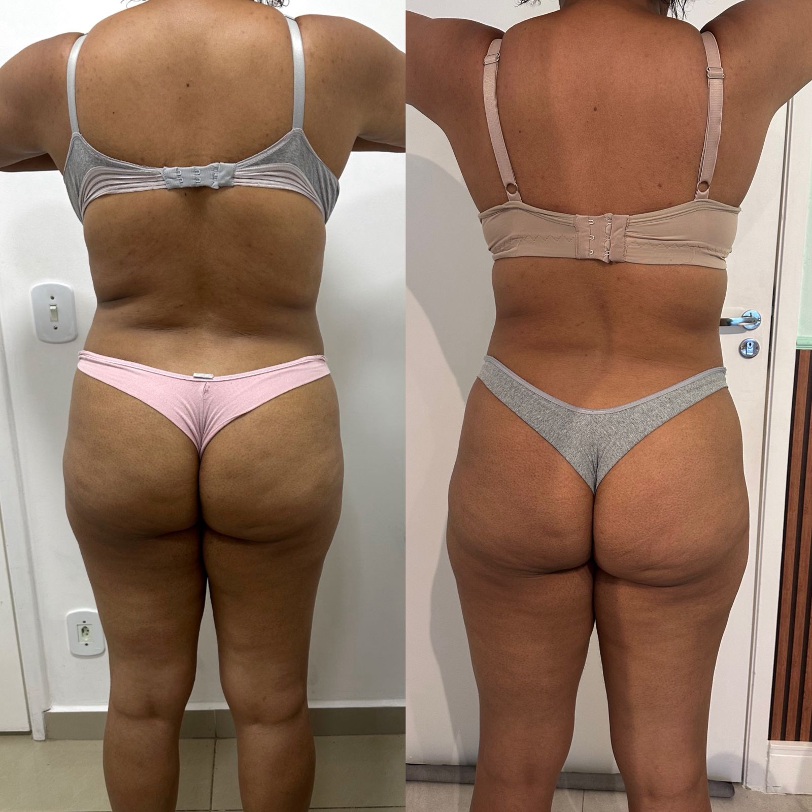 Antes e Depois Harmonização Corporal - Abdomen Perfil