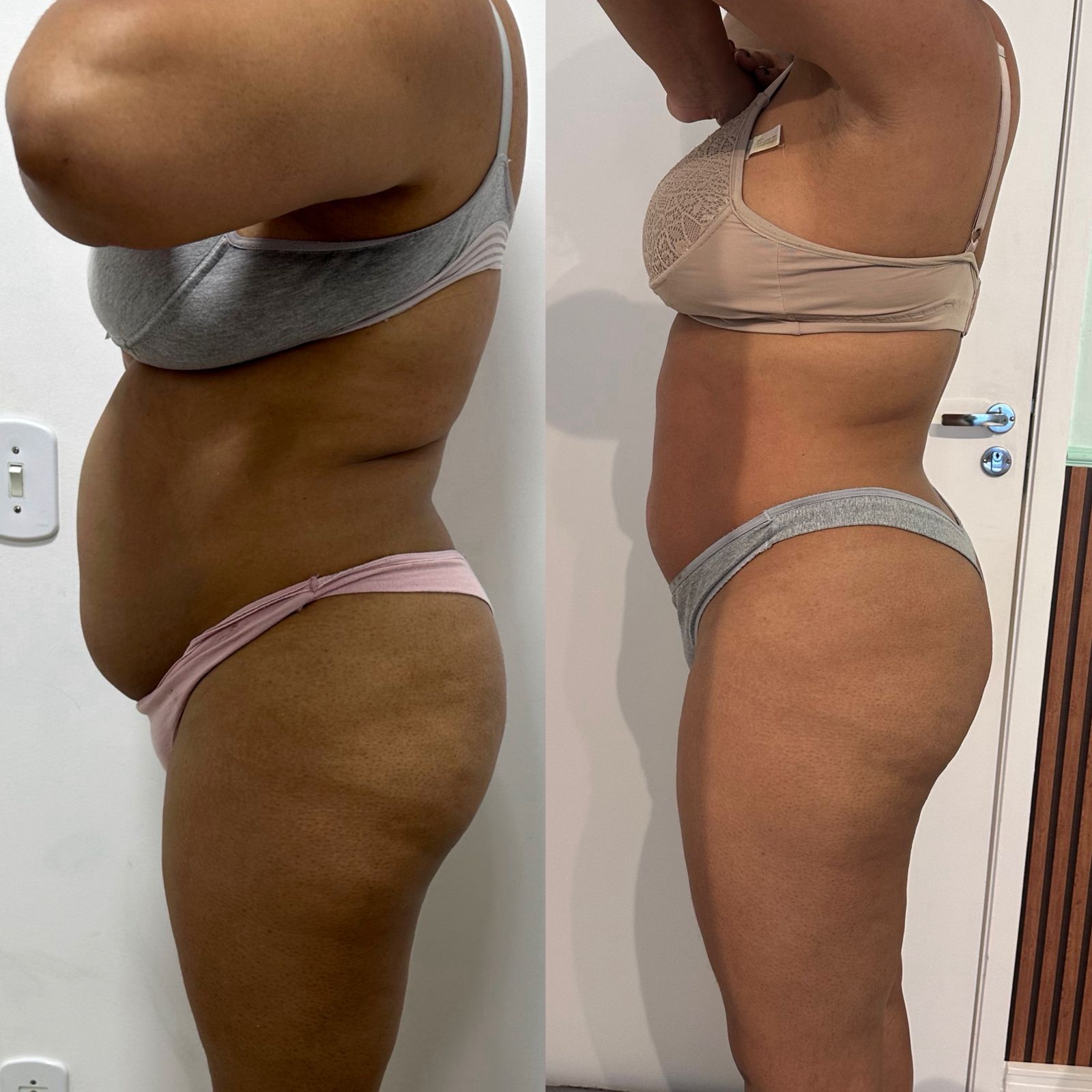 Antes e Depois Harmonização Corporal - Abdomen Lateral