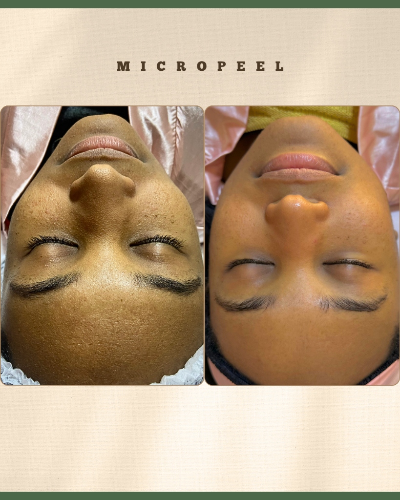 Antes e Depois Limpeza de Pele Profunda - Tatiane Gomes Estética