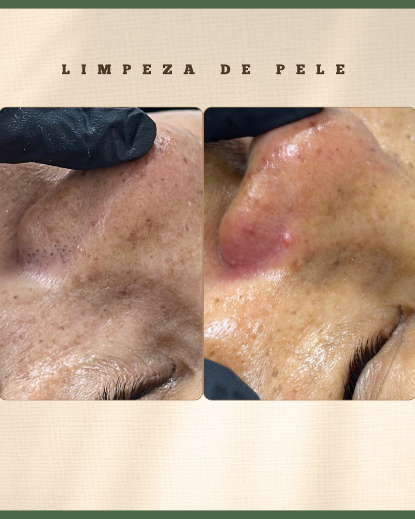 Antes e Depois Tratamento Facial - Tatiane Gomes Estética