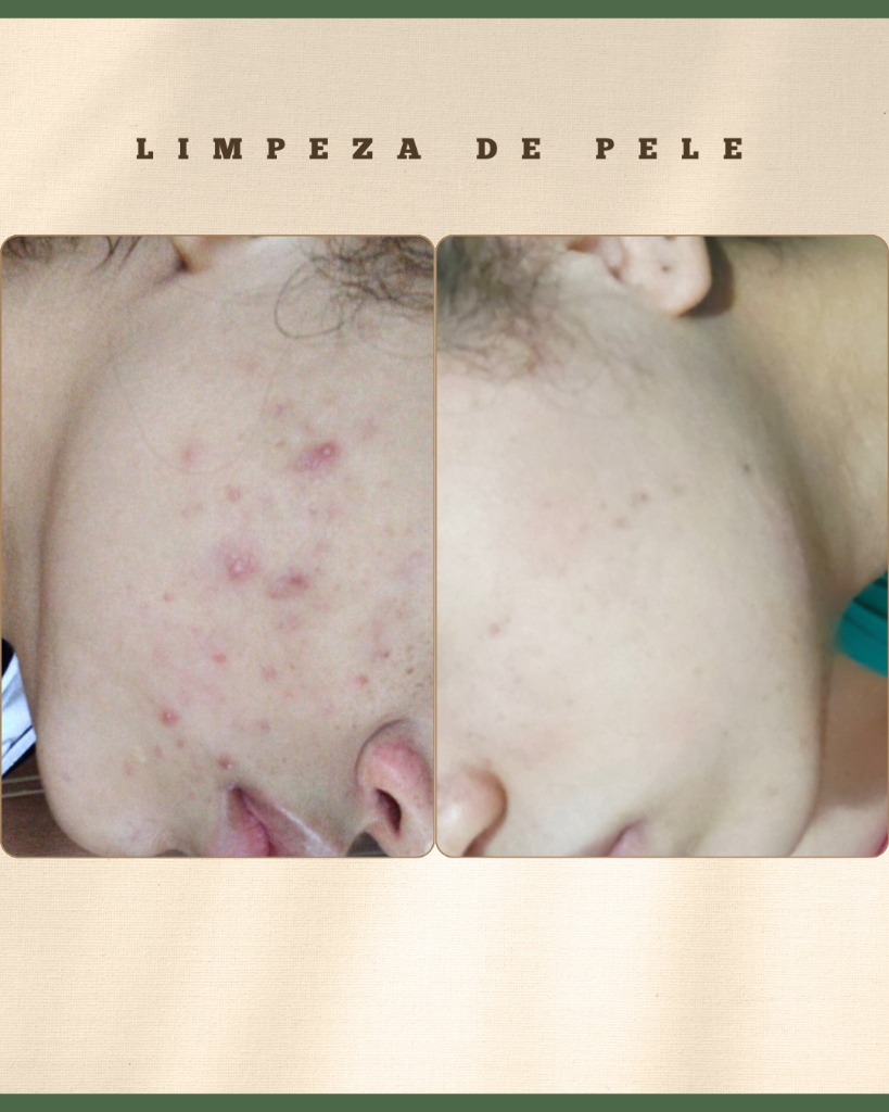 Antes e Depois Acne e Manchas - Tatiane Gomes Estética