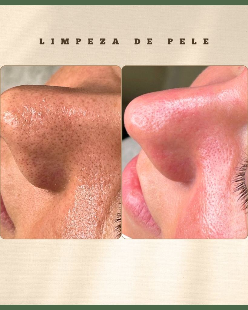 Antes e Depois Renovação Cutânea - Tatiane Gomes Estética