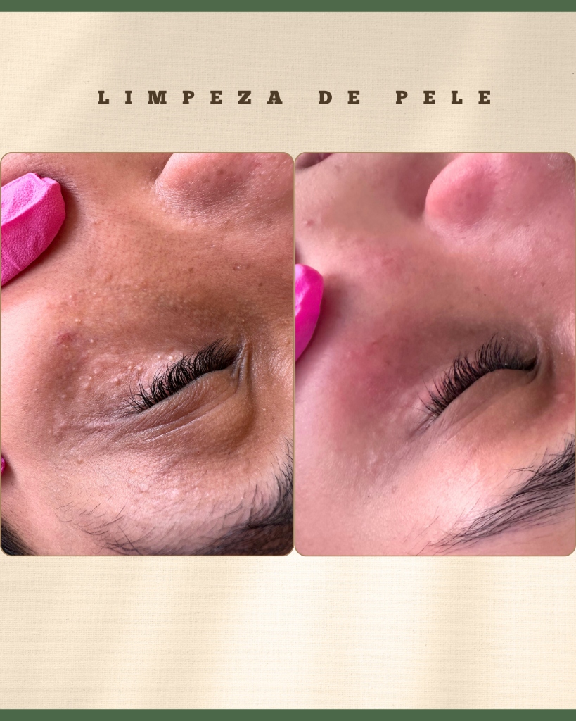 Antes e Depois Controle de Oleosidade - Tatiane Gomes Estética
